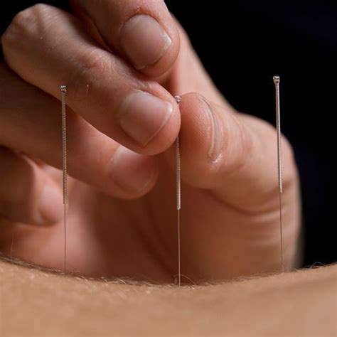 Abdominal Acupuncture