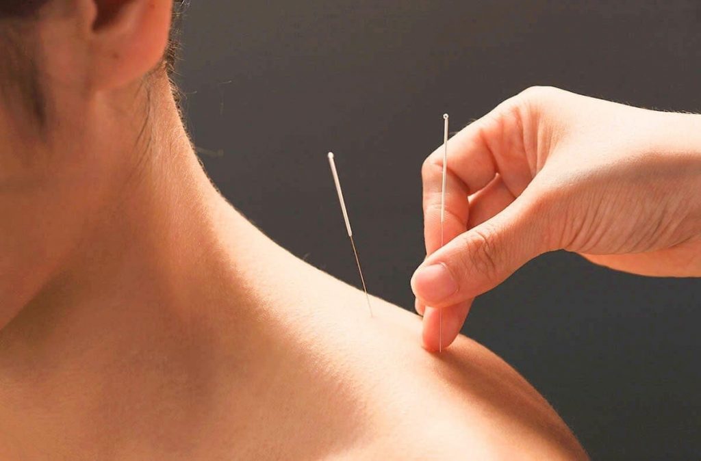 Dry Needling Clinic Cairns