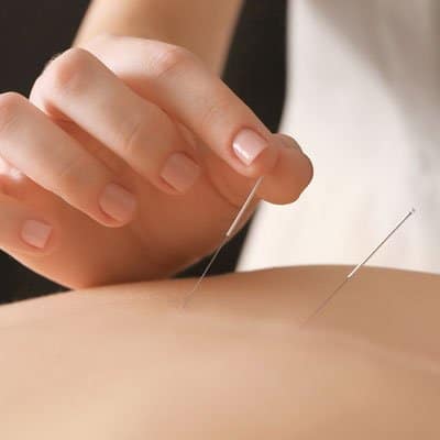 dry needling physio cairns